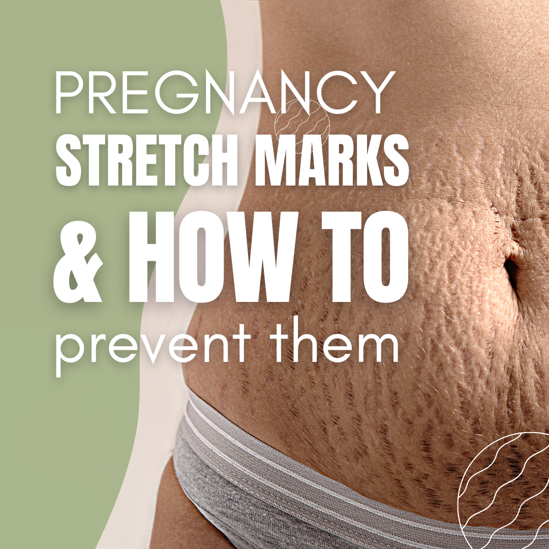 Nurturing Your Skin: Tips to Prevent Stretch Marks During Pregnancy