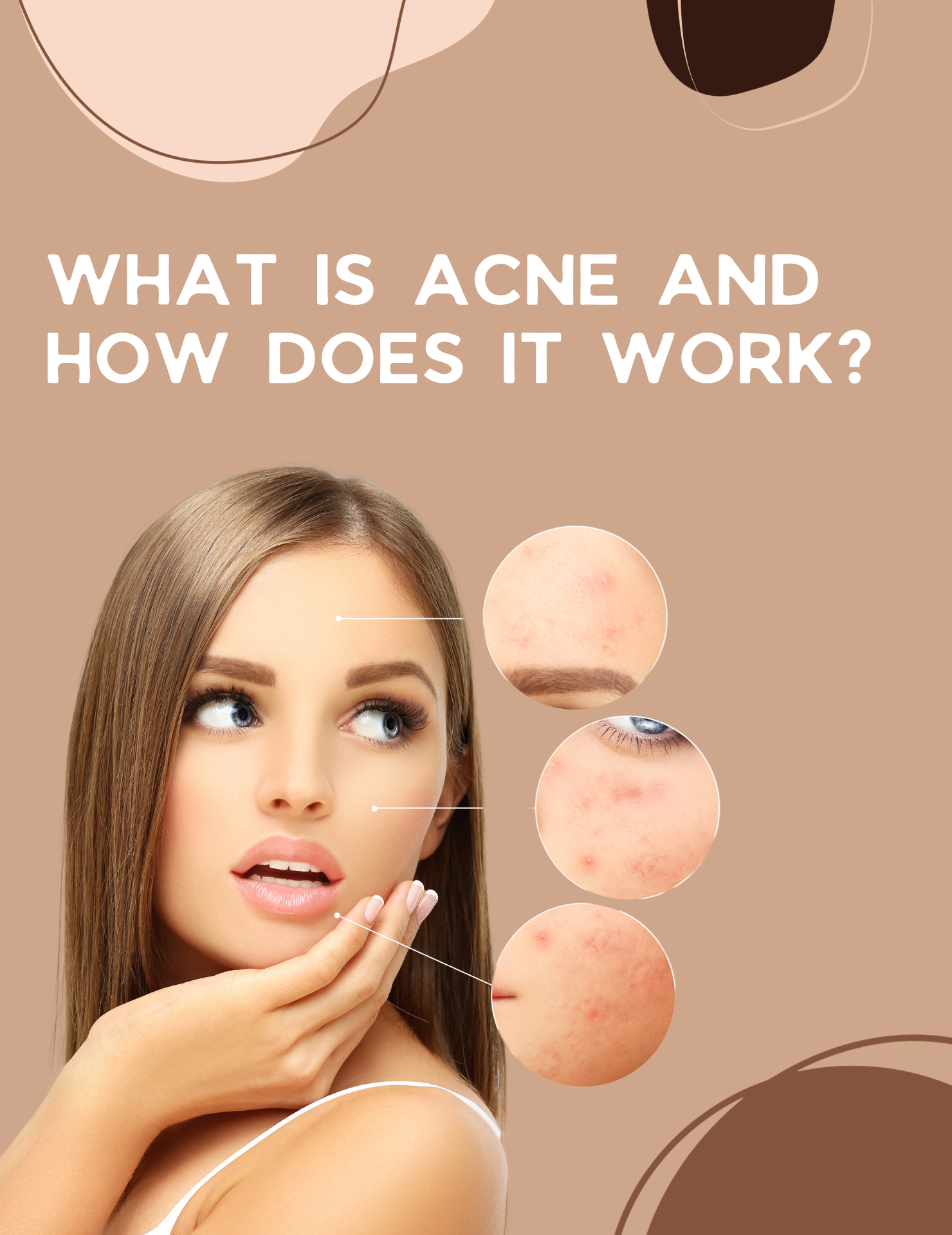 What is Acne and How Does it Work?
